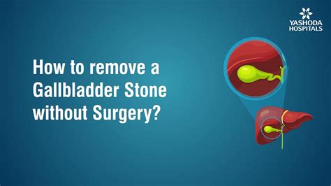 How To Remove Gallbladder Stone Without Surgery Youtube