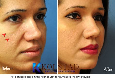 Facial Fat Transfer Before And After Gallery Dr Kolstad San Diego