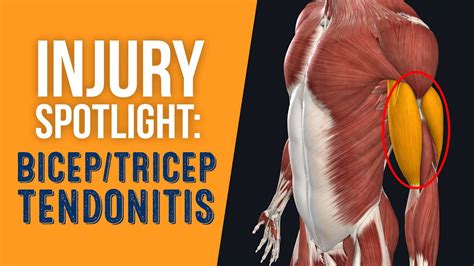 Injury Spotlight Bicep And Tricep Tendonitis Youtube