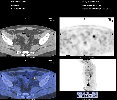 Pet And Petct In Management Of The Lymphomas Radiologic Clinics