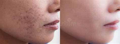 Image Before And After Dark Spot Melasma Scar Acne Pigmentation Skin