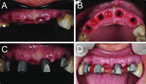 Partially Edentulous Patient With Four Implants In The Anterior