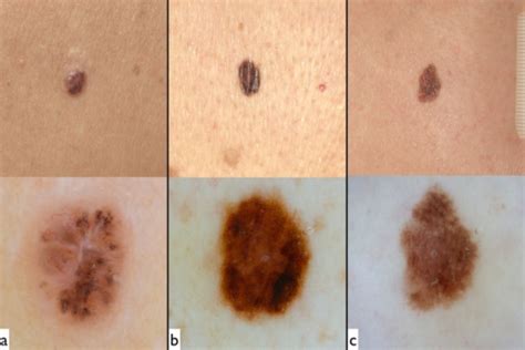Pigmented Nodular Bcc Has To Be Discriminated From Mela Open I