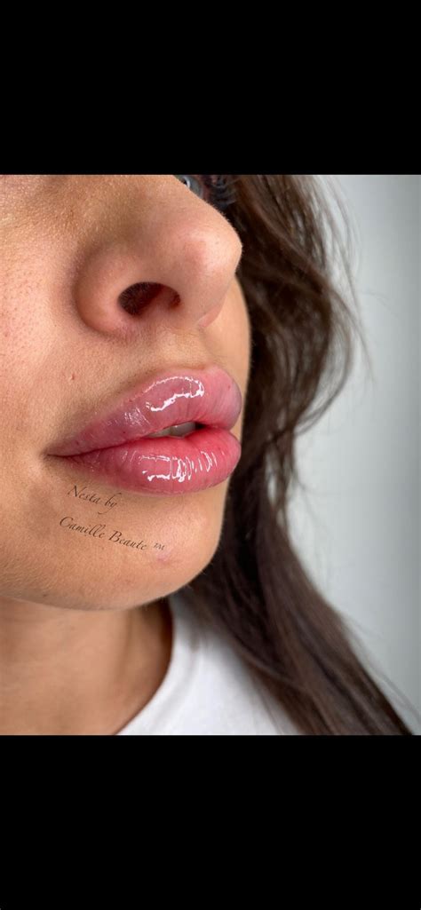 Lip Fillers London Natural Looking Results