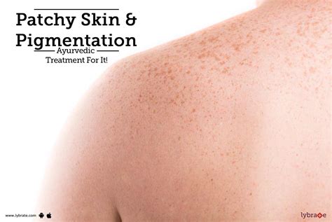 Patchy Skin And Pigmentation Ayurvedic Treatment For It By Dr Meenu