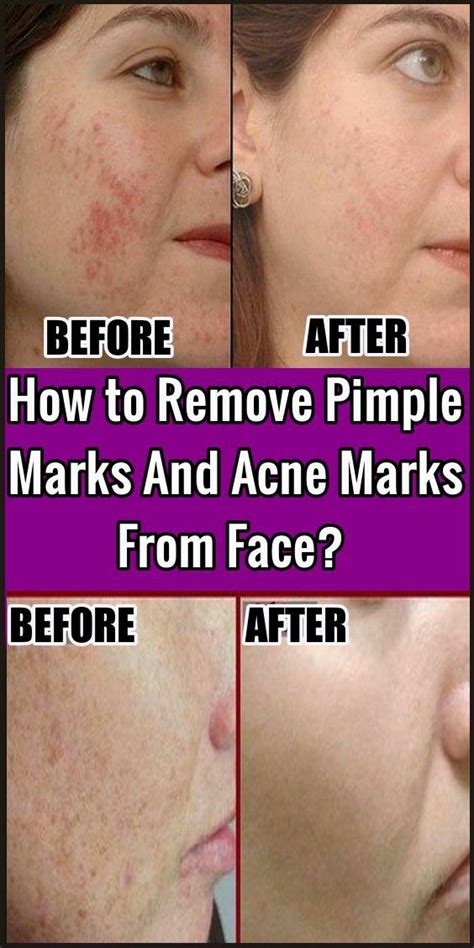 How To Remove Pimple Marks And Acne Marks From Face Face Errors
