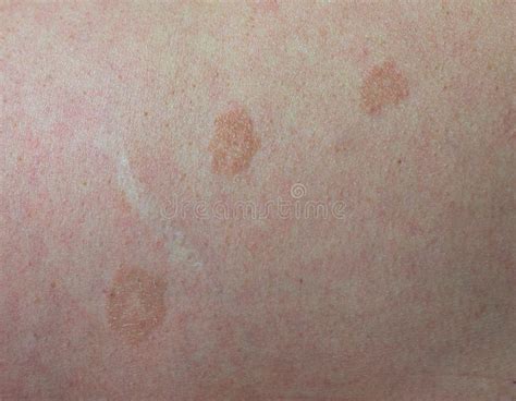 Pityriasis Versicolor Alba A And B Hypopigmented Non Scaly Macules Of