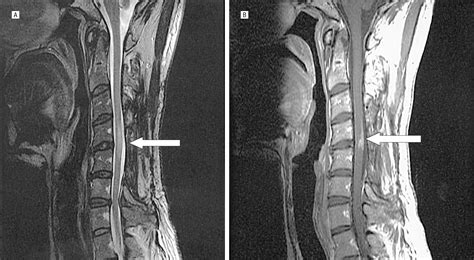 Spinal Neurosarcoidosis Mimicking An Idiopathic Inflammatory