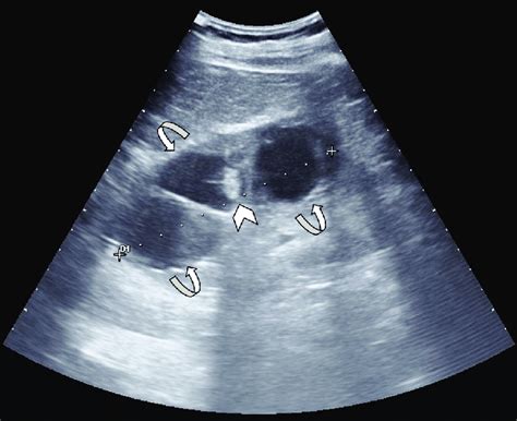 Simple right ovarian cyst, needs clinical correlation. Ultrasound image shows multiple cystic lesions (curved ...