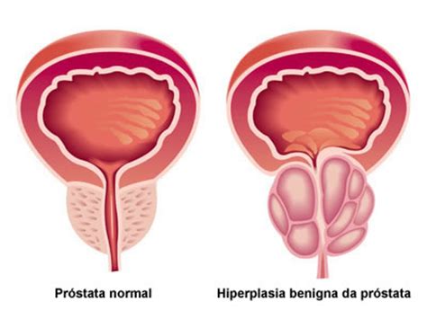 Explains prostate problems including prostatitis and benign prostatic hyperplasia. Hiperplasia benigna da próstata (HBP) | Criasaude