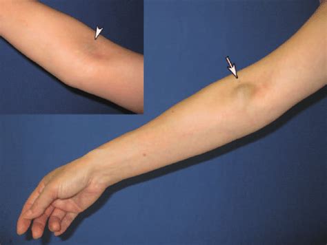 Physical Examination Of A Soft Mass On The Right Arm Of A 58 Year Old