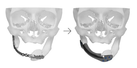 Reconstruction Of The Mandible Using An Individual Bone Implant With