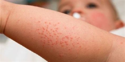 Dermatite Atopica Sintomi Cause E Rimedi Efficaci Artofit