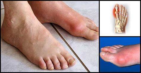 Helpful Tips To Prevent Gout Attacks Dr Farrah Md