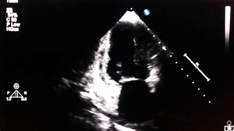 Echocardiogram Akinesia Of The Inferior Wall Youtube