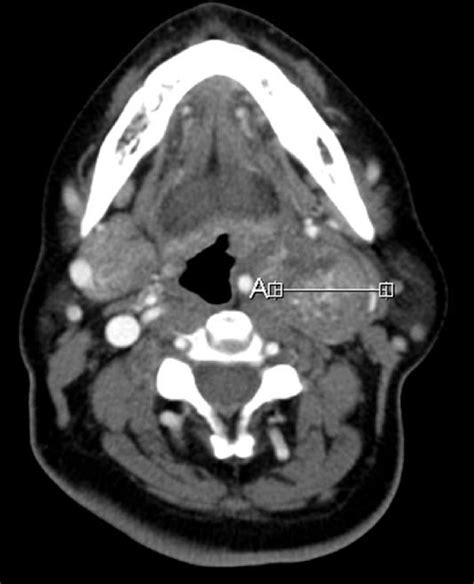 Contrast Enhanced Computed Tomography Ct Scan Of The Neck Showing A