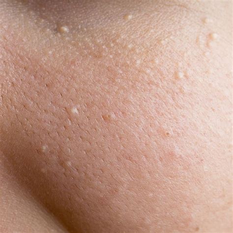 Whats That On Your Face Skin Bumps Skin Tags On Face White Bumps
