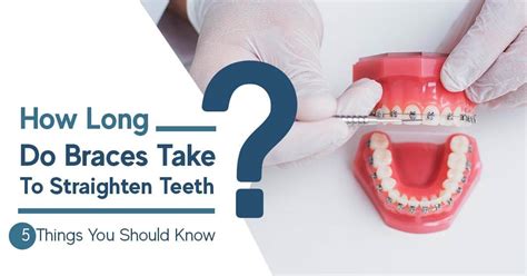How Long Do Braces Take To Straighten Teeth Things You Should Know