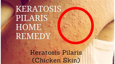 Keratosis Pilaris Home Remedy Keratosis Pilaris Chicken Skin Youtube