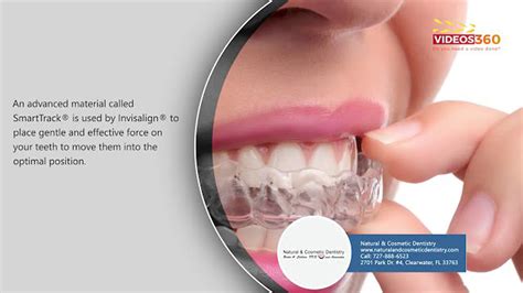 Invisalign Treatment Clearwater Fl Invisible Clear Teeth Aligners