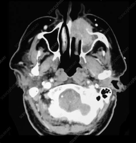 Ct Squamous Cell Carcinoma Head And Neck Stock Image C0430376