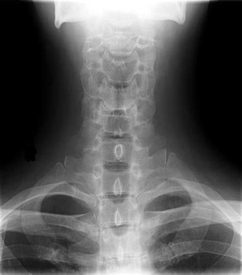 Treatment for cervical spondylosis depends on the severity of your signs and symptoms. FDA clears NuVasive's latest spine surgery system ...