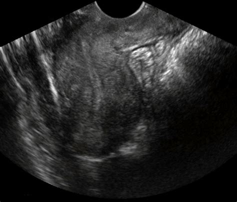 Obgyn Images Transvaginal Ultrasound Ultrasound Sonography