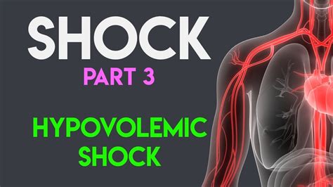 Hypovolemic Shock Shock Part 3 Youtube