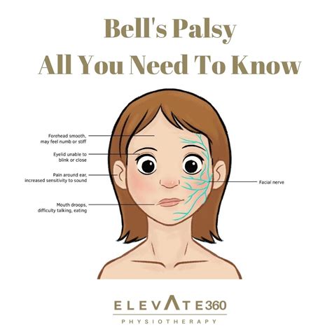 27 видео 755 просмотров обновлен 21 июл. Bell's Palsy- All You Need To Know - Elevate Physiotherapy