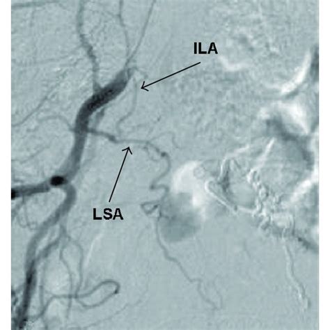 Spinal Angiogram Through Right A And Left B Internal Iliac Artery