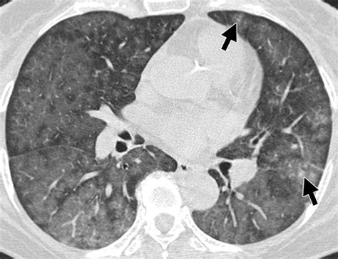 Pulmonary Intravascular Lymphomatosis Clinical Ct And Pet Findings