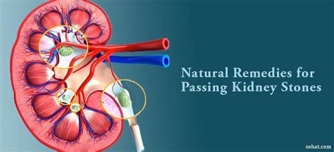 10 Effective Natural Ways Of Passing Kidney Stones Fast Sehat