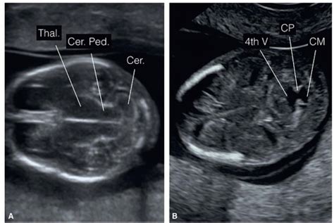 Fetal Brain Ultrasound Images