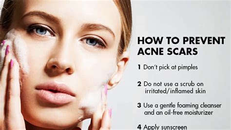 15 Best Acne Treatment Products Youtube