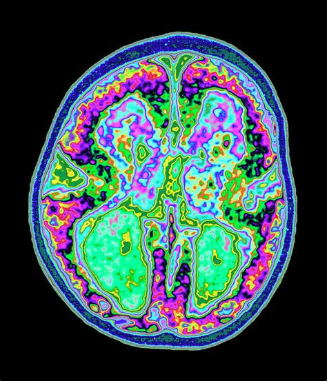 Coloured Mri Brain Scan Showing Lissencephaly Photograph By Mehau Kulyk