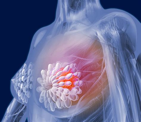 Inflammatory Breast Cancer A Rare And Aggressive Malignancy Clinical