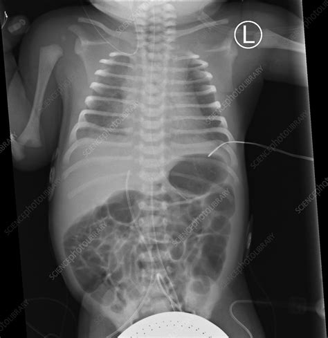 Premature Neonate X Ray Stock Image C0526864 Science Photo Library
