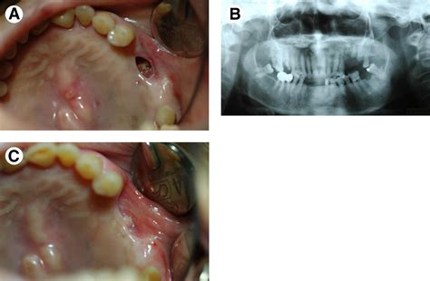 Resolution Of Oral Bisphosphonate And Steroid Related Osteonecrosis Of