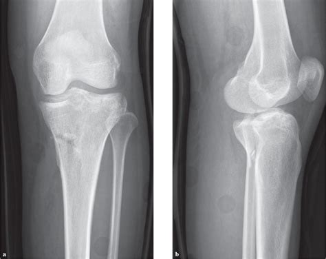 Posterior Tibial Plateau Fracture Treatment