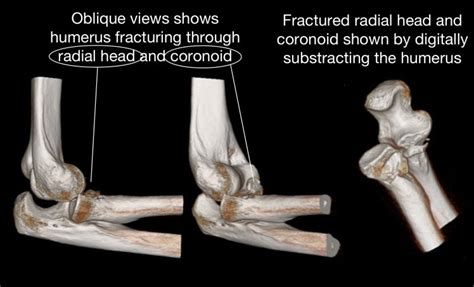 Why Is It That Surgeons Call Certain Elbow Injuries “terrible Triad