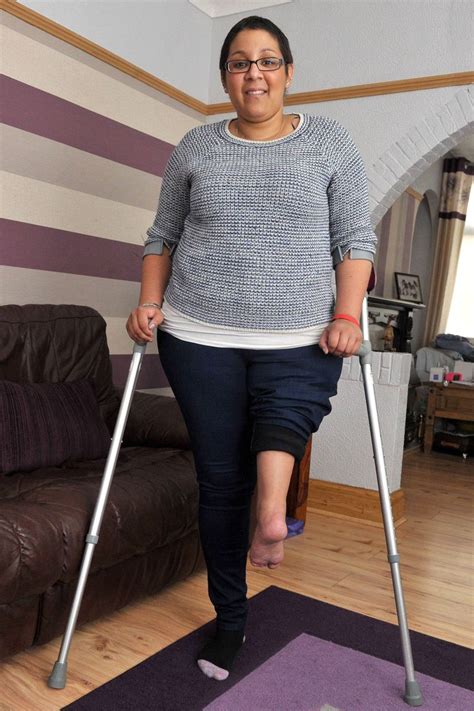 Amputee Woman Has Ankle Made Into Knee Mirror Online