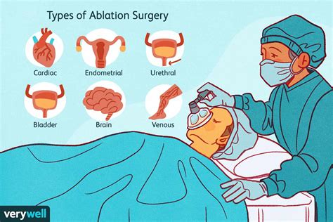 Ablation Surgery How To Prepare