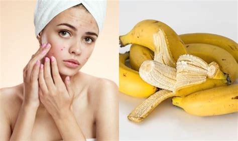 Went to the doctor and did the freeze off method, by the way, she did not like that at all!!! Banana Can Remove Acne: How to Use Fruit Peel to Get Rid ...