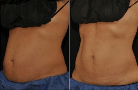 Coolsculpting Elite® Boston Non Surgical Fat Reduction Wellesley Krauss Dermatology