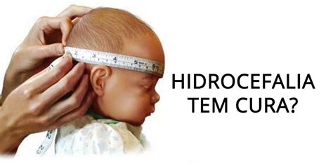 A hidrocefalia tem cura Clínica da Coluna Dr Fernando Schmidt e