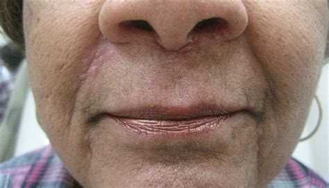 Acne Like Rash Around The Nose And Mouth Clinical Advisor