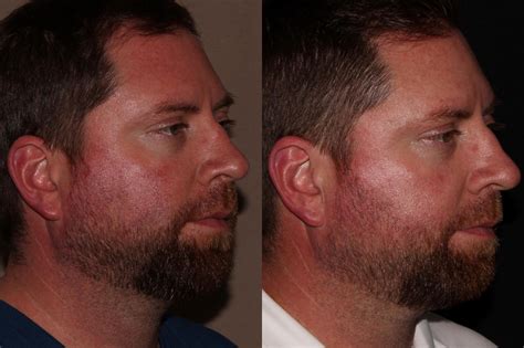 BBL PhotoFacial Before And After Pictures Case Chico Yuba City Oroville CA Hodari MD