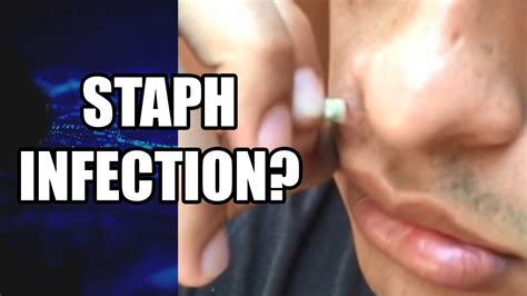 Face Cyst Staph Infected Cyst Extraction What Is It Largest Infected Pimple Youtube