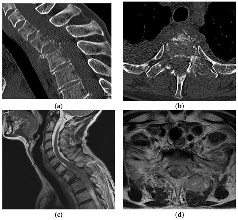 Jcm Free Full Text Does The Pathologic Fracture Predict Severe