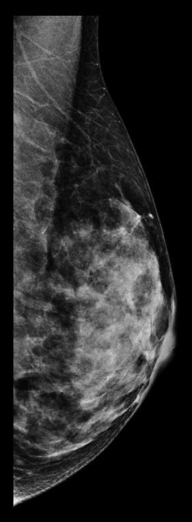 Normal Mammography Dense Breasts Image